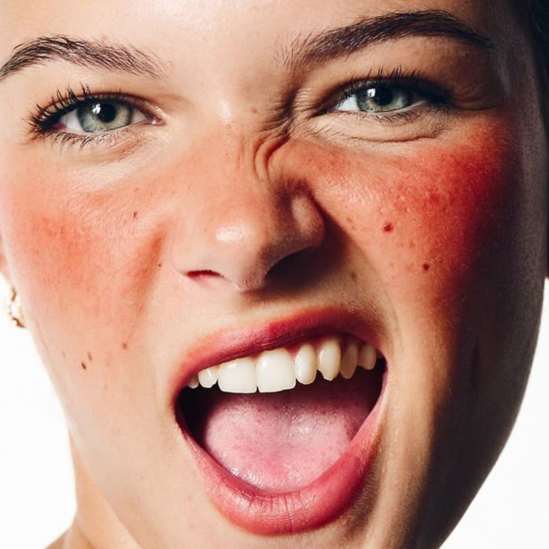 Skincare routine for rosacea