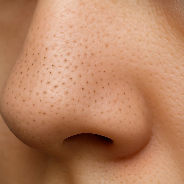 Sebaceous Filaments: Why You Should Stop Removing Them