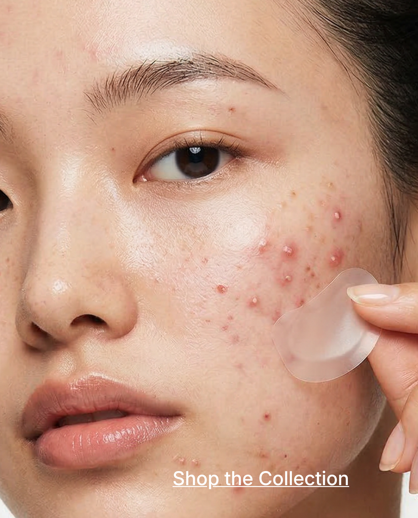 Acne Care